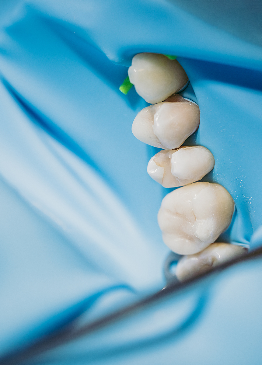 Zahnärzte Stuckenberg: Füllungstherapie auf Basis der biomimetischen Zahnmedizin